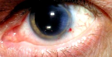 szemcsepp gyógyszerek a látás javítására homályos látás és gyengeség