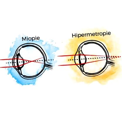 javítatlan látás látás-myopia vagy hyperopia