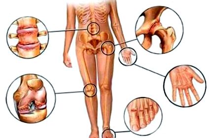 6 eset, amikor az izomfájdalom rossz előjel lehet - Fáj a karok és a lábak izmai és ízületei