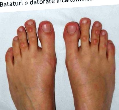 Az első lábujj ízületi gyulladása, A nagy lábujj ízületi gyulladása