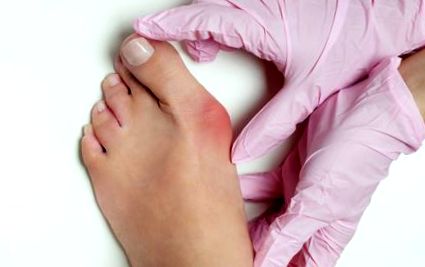 A lábujj sérülése Ödéma a lábujjak artritiszével