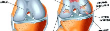 Karpantikus alagút és arthritis - Ízületi gyulladás - - Carpal osteoarthrosis kezelés