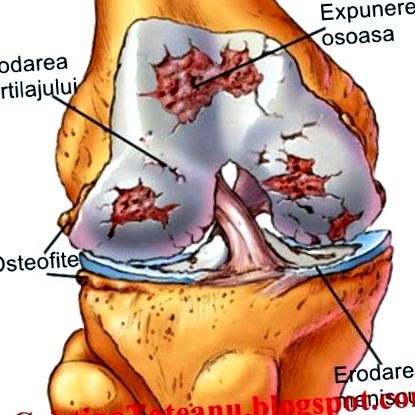 deformáló osteoarthritis nagy ízületek a distalis proximális interphalangealis ízületek osteoarthritis