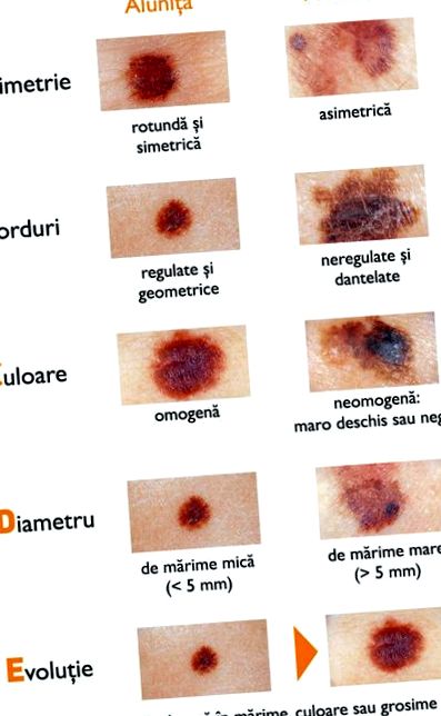 Bőrparaziták tünetei - Bőratka bőrgyógyászati kezelése
