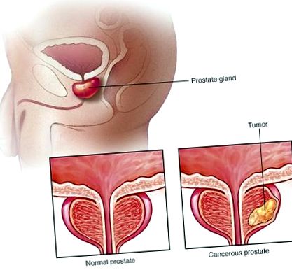 A prostatitis eltávolítja a gyulladást