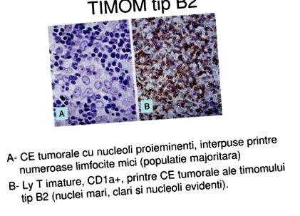 b2 típusú thymoma rák)