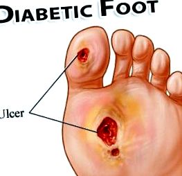 Diabéteszes láb kezelése - Cukorbetegközpont