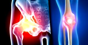 A csípőízület osteoarthritisének tünetei