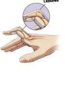 A kézkezelés ujjainak ízületeinek polyosteoarthrosisa