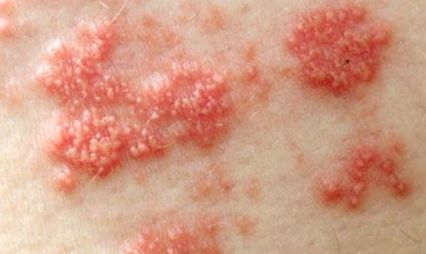 allergiás dermatitis kezelés cukorbetegséggel
