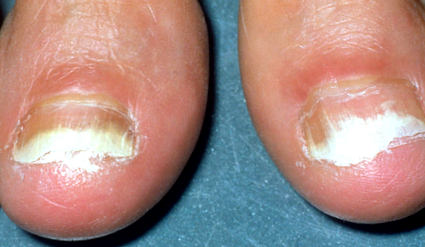 Malyshev gomba lábak és a körmöket - a megfelelő kezelés