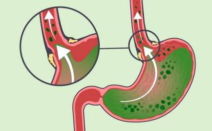 Böfögő dysbiosis. Méregtelenítés liv vel