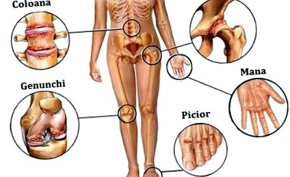 poszttraumás artritisz a bokaízület kezelése