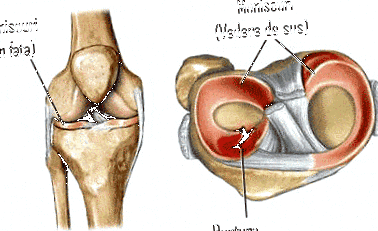 A térd medialis meniscusának repedése. Porcleválás és térdműtét