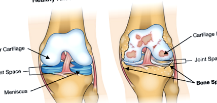 A jobb vállízület deformáló artrózisa 3 fok. Osteoarthritis 1 fok kezelés