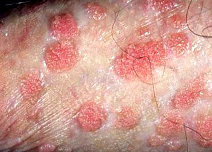 HPV (humán papilloma vírus) fertőzés - A papilloma vírus meggyógyul
