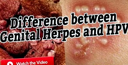Herpesz: ajakherpesz és nemi herpesz - Hpv vagy herpesz, amelyek nekem vannak