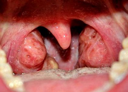 Uvula papilloma kivágása. Hpv szemölcsök a nyelven