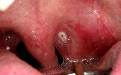 vírusos papilloma uvula távolítsa el a Lyubertsy papillómát