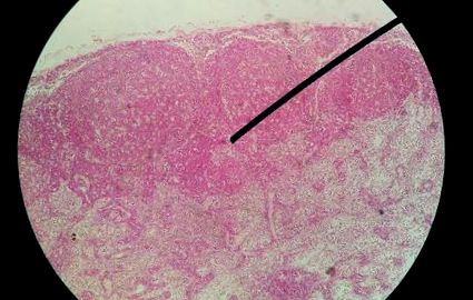 magas onkogén kockázatú humán papillomavírus