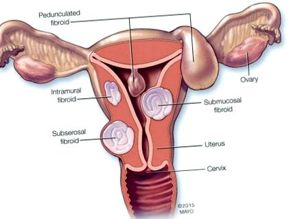 peritoneális petefészekrák