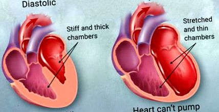 mennyire hasznos a csipkebogyó magas vérnyomás esetén női szív egészségére vonatkozó tudatosság
