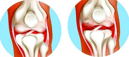 A vállízület chondrosisának kezelése otthon mi az 1 fokos csípőízület artrózisa