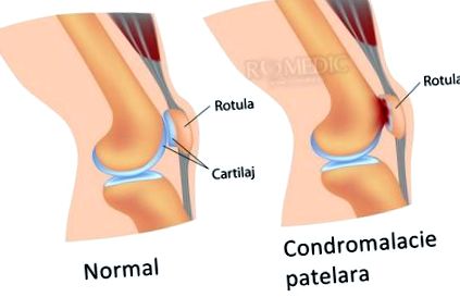 Gonarthrosis a térdízület kezelésének 3 stádiuma. A térdízület kopásának tünetei