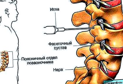 A nyaki osteochondrozis kezelésére szolgáló gyógyszerek komplexe