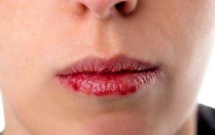 papilloma vírus ajkak száj
