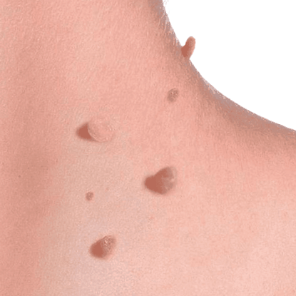 Papilloma nyakon, Papillary thyroid cancer side effects