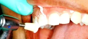 povrchu zubov