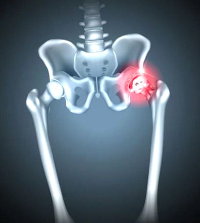 kismedencei osteoarthritis)