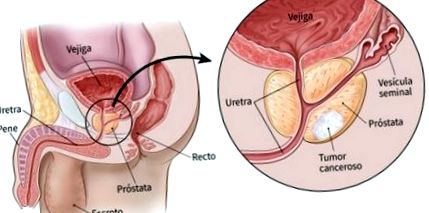 prostatitis mágnes mint a prosztatitis betegségét férfiakban