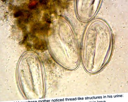 férgek felnőtteknél tünetek paraziták a széklet mikroszkópiájában
