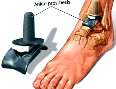Arthrosis okai és kezelése 1 fok - a betegség tág mérete A bal boka ízületének artrózisa 1 fok