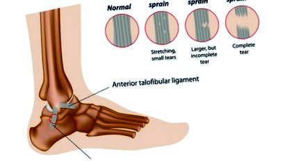 boka osteoarthritis kezelésére szolgáló gyakorlatok boka porcgyulladása