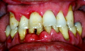 periodontitis kezelése cukorbetegeknél)