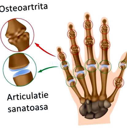 Arthritis és arthrosis: mi a különbség?