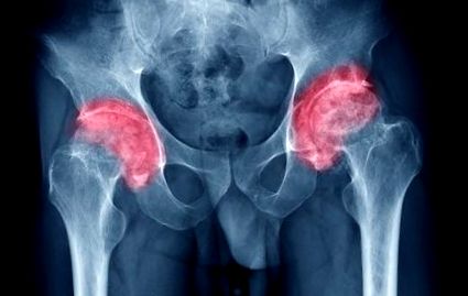 a csípőízület poszttraumás osteoarthritisének kezelése