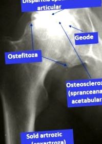 csípő osteoarthritis hogyan kezelhető vállízületek ízületi gyulladása