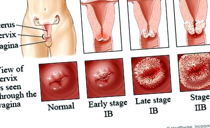 humán papillomavírus hpv ozmózis