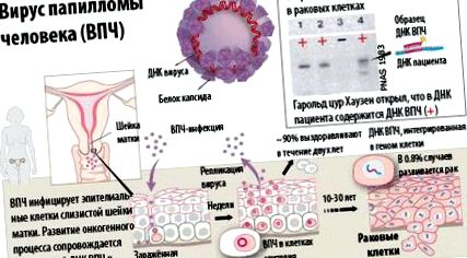 Papilloma vírus haqida - A HPV (humán papillomavírus) fertőzés tünetei, kezelése