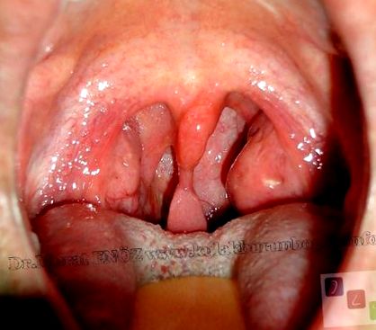 papilloma uvula jóindulatú