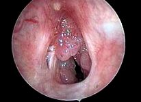 Uvula papilloma tünetei. A gége jóindulatú daganatai