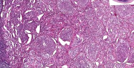rák neuroendokrin sejtek