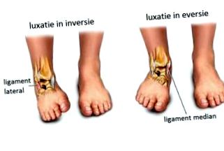 a láb boka gyulladása csípőízület coxarthrosis vagy arthrosis