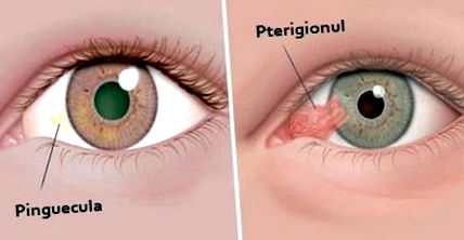 pterygium és látás