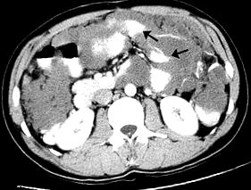 Peritonealis szindróma - Peritonealis pseudomyxoma rák