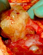 Peritonealis pseudomyxoma rák. Pseudomyxoma peritoneum: okok, tünetek, diagnózis és kezelés